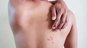 Percutane effective on Shingles and nerve pain